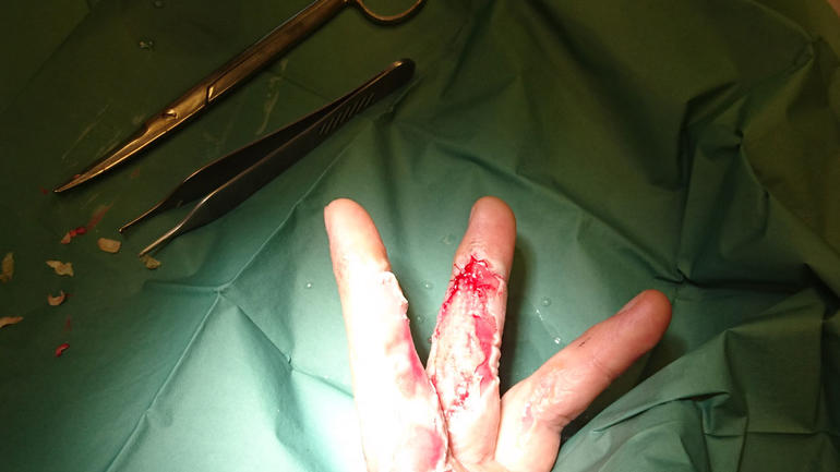 En sår finger behandles ved sårpoliklinikken ved Drammen sykehus