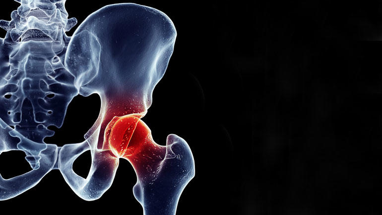 røntgenbilde der hofteleddet er uthevet med rød farge. illustrasjon